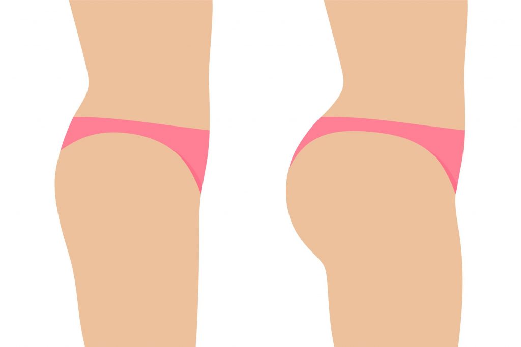 Brazilian Butt Lift (BBL)
